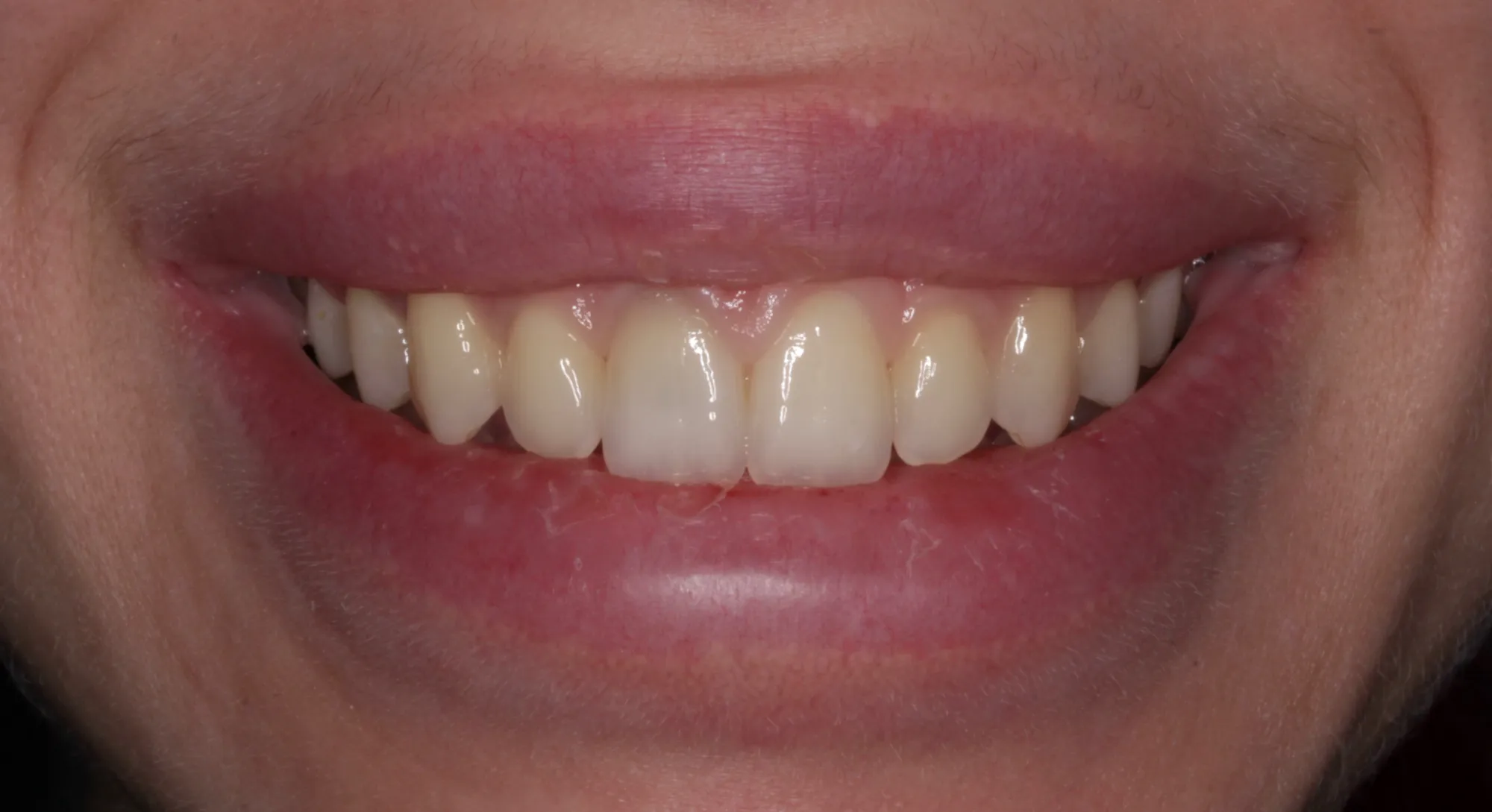 Full Mouth Rehabilitation in Gangapur Road Nashik: A Complete Guide to Restoring Your Smile and Oral Health