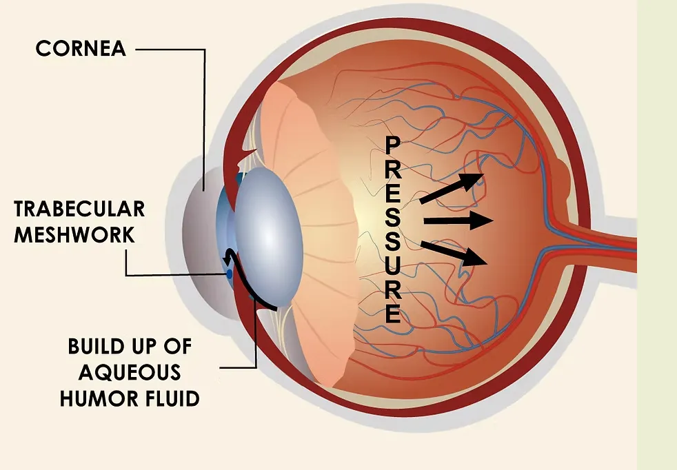Ayurvedic Treatment for Glaucoma – Restoring Optic Nerve Health Naturally