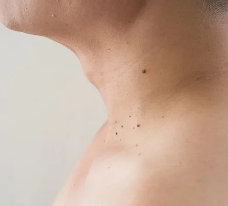 Why You Should Have Your Moles Checked Often