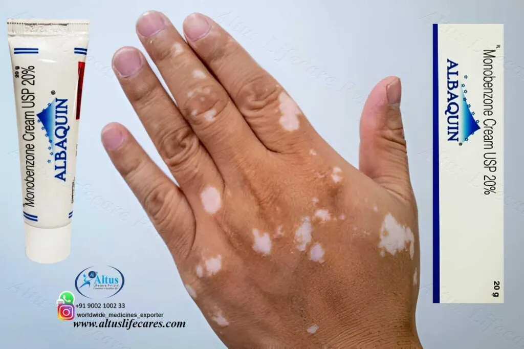 Albaquin 20 Cream (Monobenzone) for Vitiligo Treatment