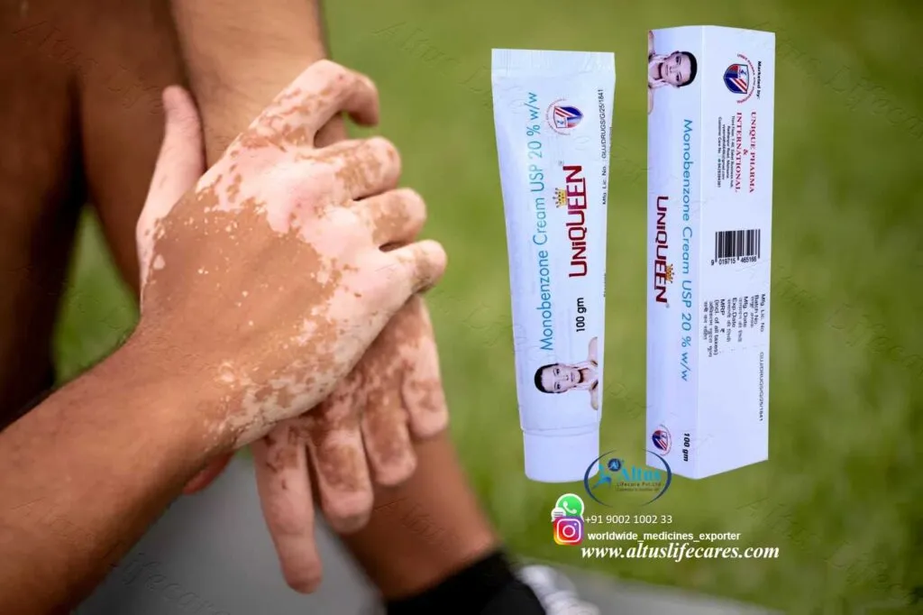 Uniqueen 20 Cream Monobenzone for Vitiligo Treatment