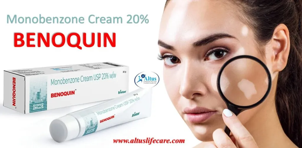 Uniqueen 20 Cream Monobenzone for Vitiligo Treatment