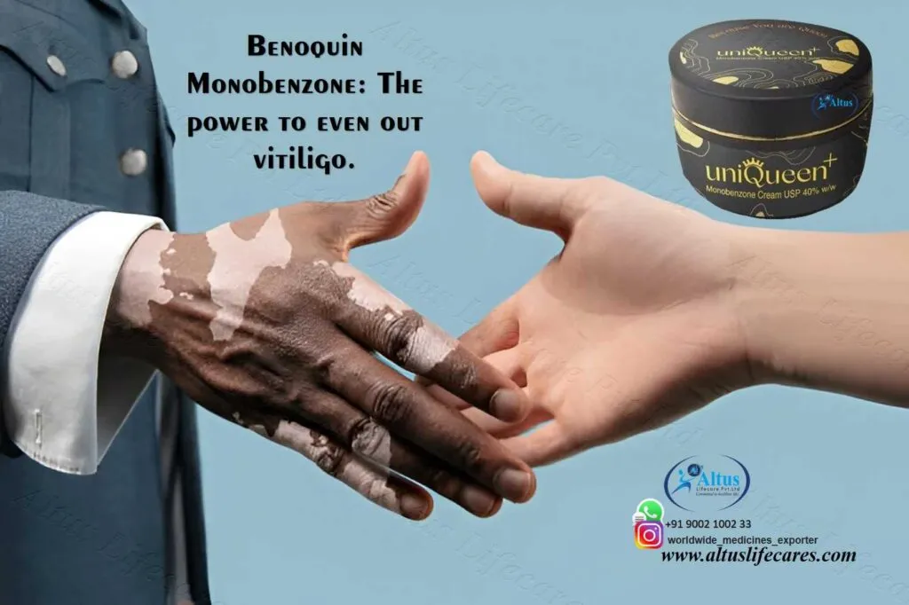 Uniqueen 40 Cream Monobenzone for Vitiligo Treatment