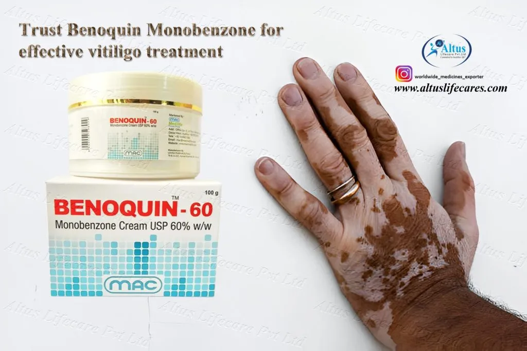 Uniqueen 60 Cream Monobenzone for Vitiligo Treatment