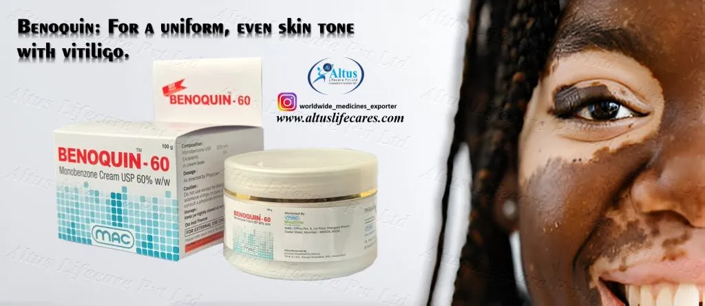 Uniqueen 60 Cream Monobenzone for Vitiligo Treatment