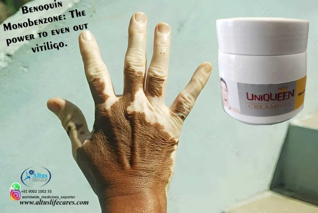 Uniqueen 60 Cream Monobenzone for Vitiligo Treatment