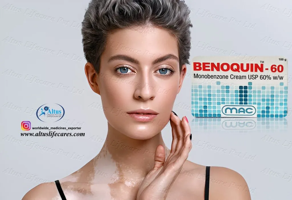 Uniqueen 80 Cream Monobenzone for Vitiligo
