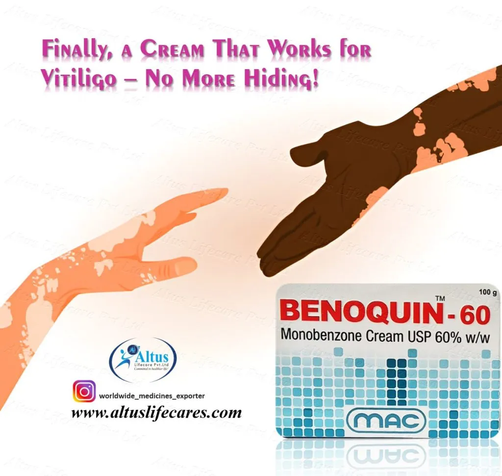 Uniqueen 80 Cream Monobenzone for Vitiligo