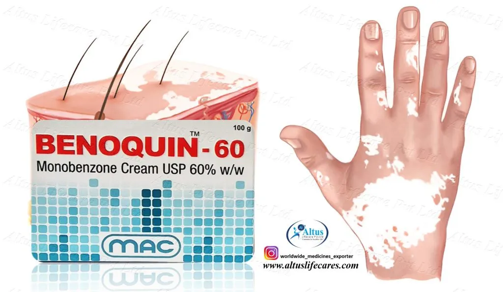 Uniqueen 80 Cream Monobenzone for Vitiligo