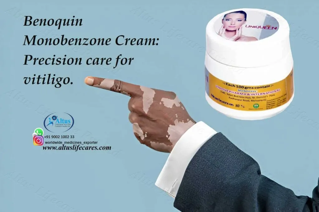 Uniqueen 80 Cream Monobenzone for Vitiligo