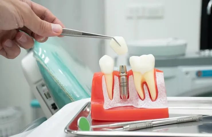 How to Find the Best Dental Implants Near Me for Long-Lasting Results