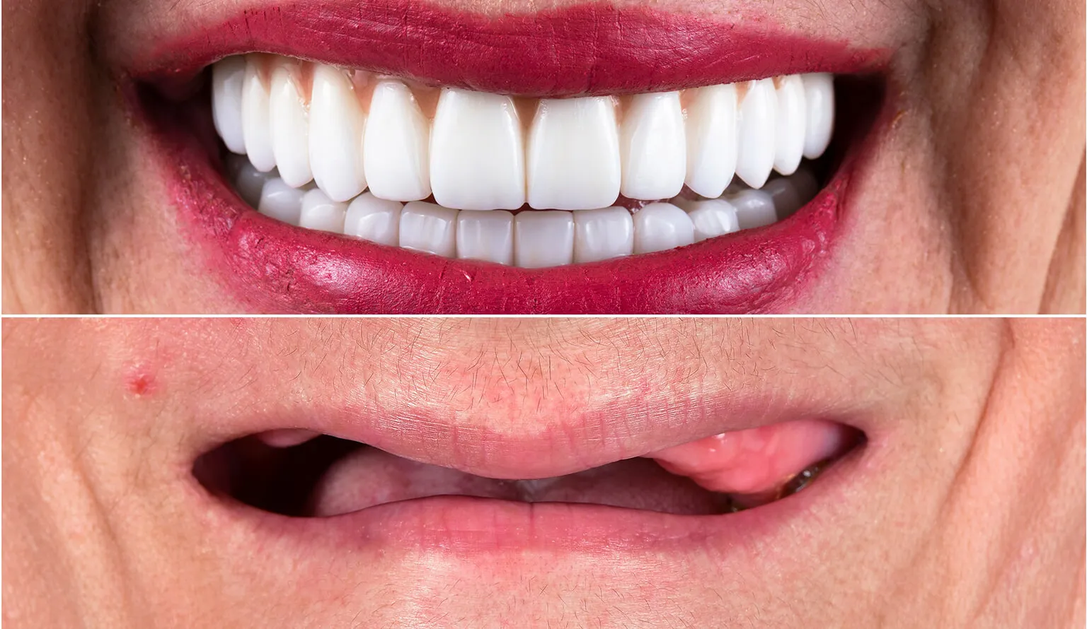 Full Mouth Rehabilitation Treatment Before and After What to Expect