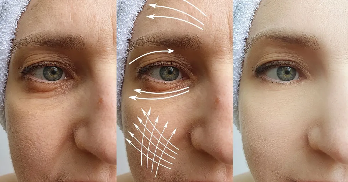 9 Powerful Under Eye Wrinkle Treatment Options for Youthful Skin