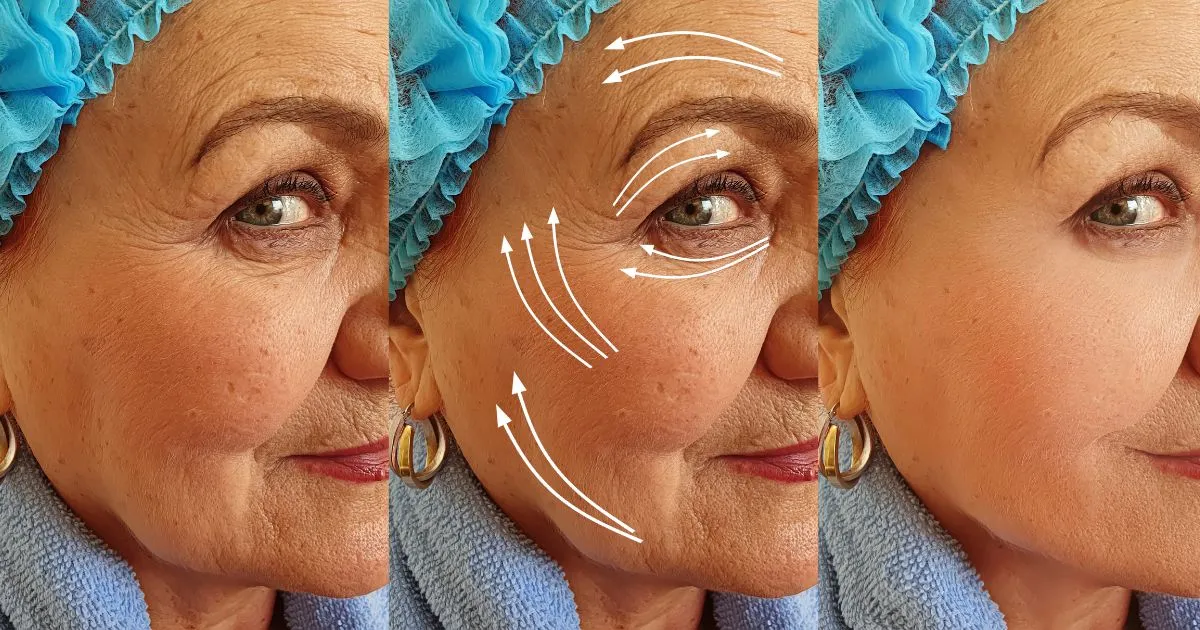 9 Powerful Under Eye Wrinkle Treatment Options for Youthful Skin