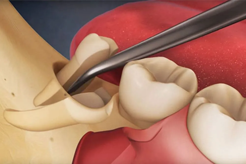 Signs Your Wisdom Tooth Needs Extraction