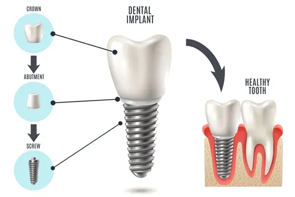 From Gaps to Great Smiles: Your Dental Implant Journey
