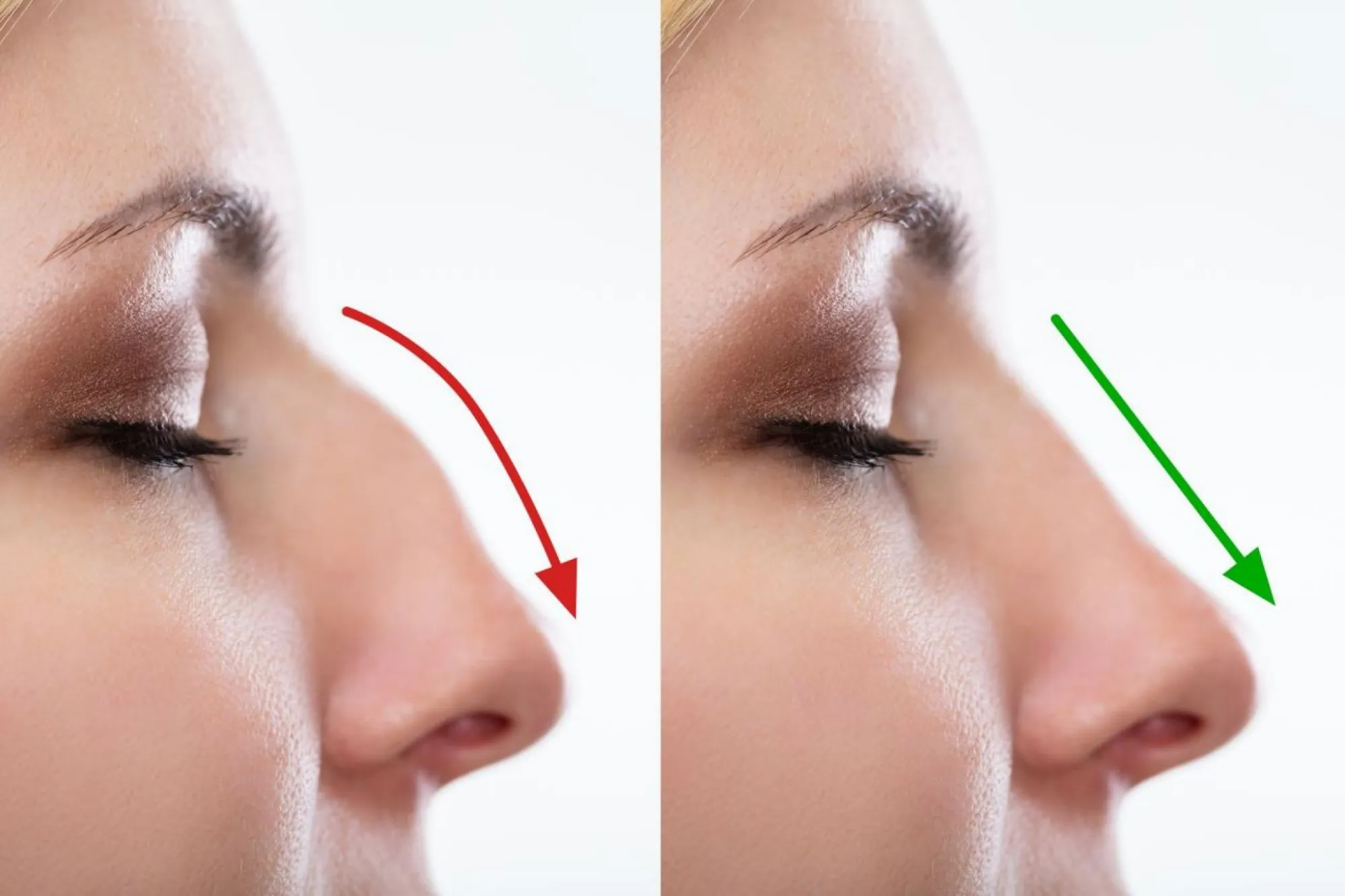 Can You Actually Get The Perfect-Shaped Nose With Surgery?