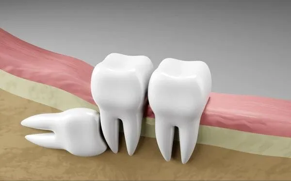 Common Problems Caused by Impacted Wisdom Teeth