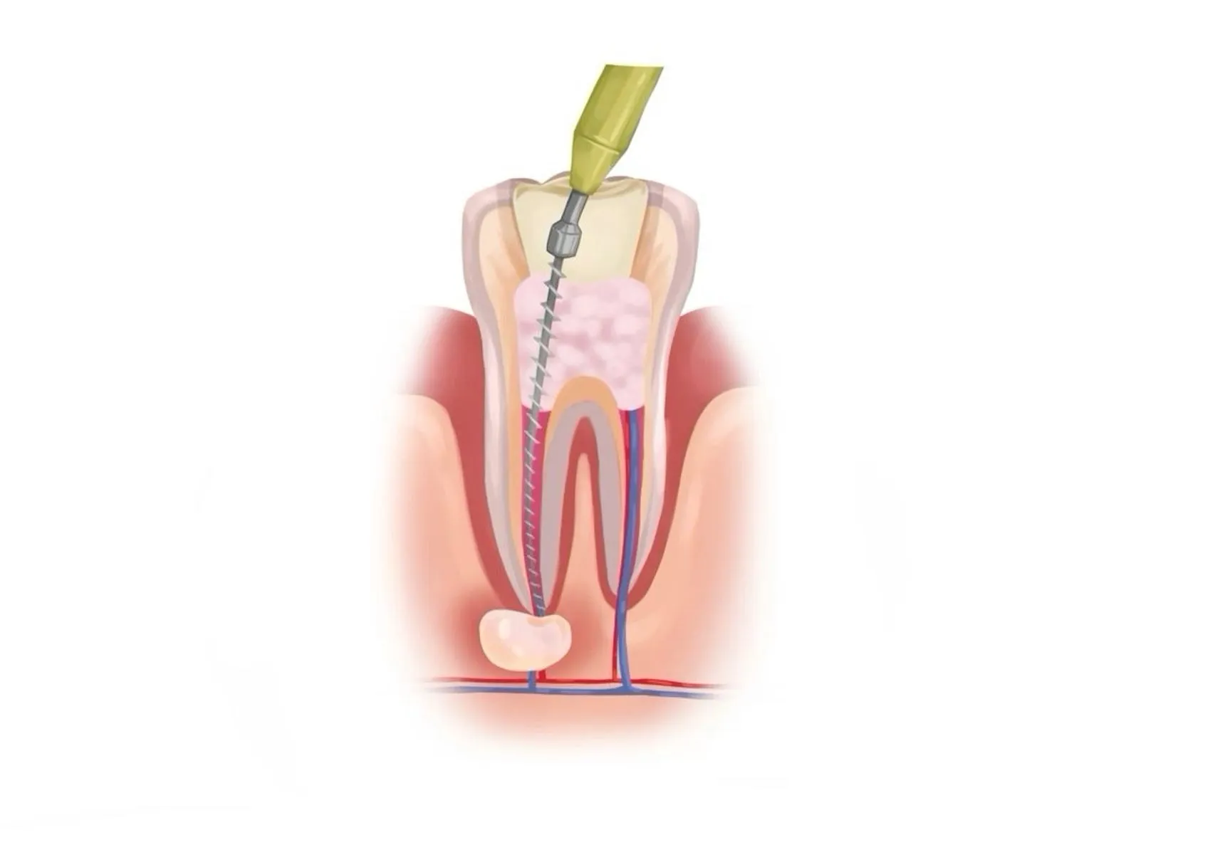 Root Canal Treatment for Severe Tooth Infection