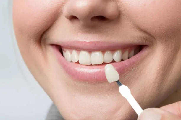 Dental Veneers: Types, Benefits, Cost & Procedure