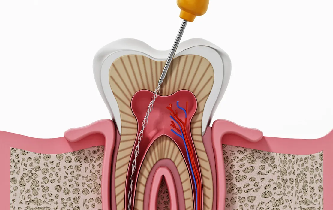 Real Cost of Root Canal Treatment in Nizamabad : No Hidden Charges Guide