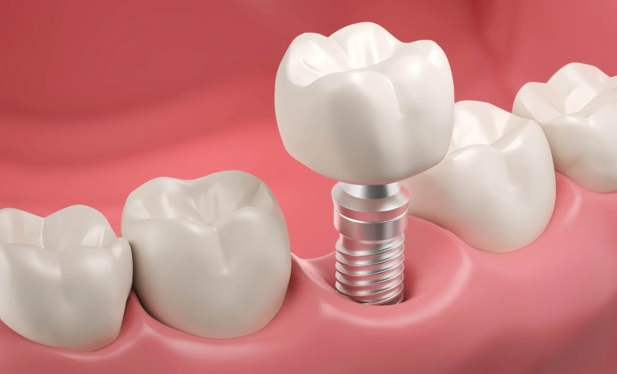 6 Immediate Dental Implant Aftercare Tips