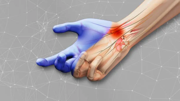 Carpal Tunnel Syndrome Treatment in KL Solutions for Long Term Wrist Health