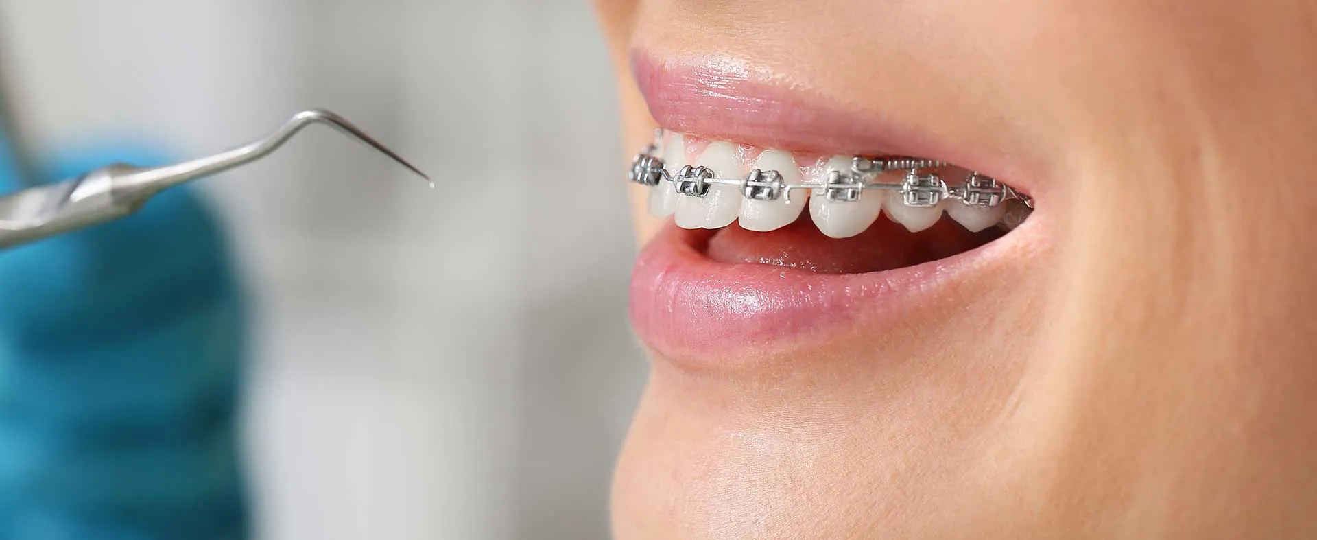 Why Braces Treatment Is Worth It: Benefits Beyond Aesthetics