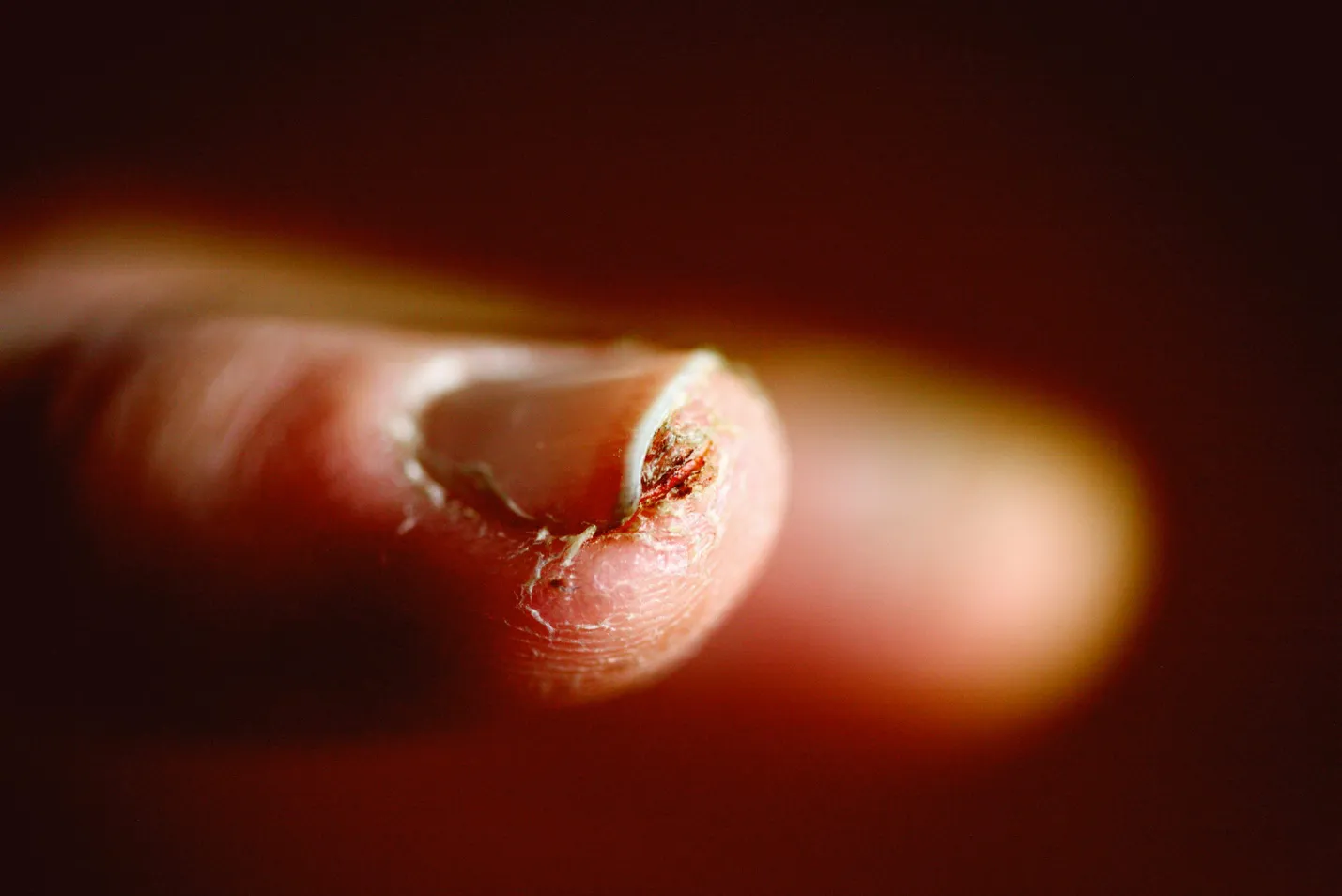 A Complete Guide to Nail Infections and Their Treatment