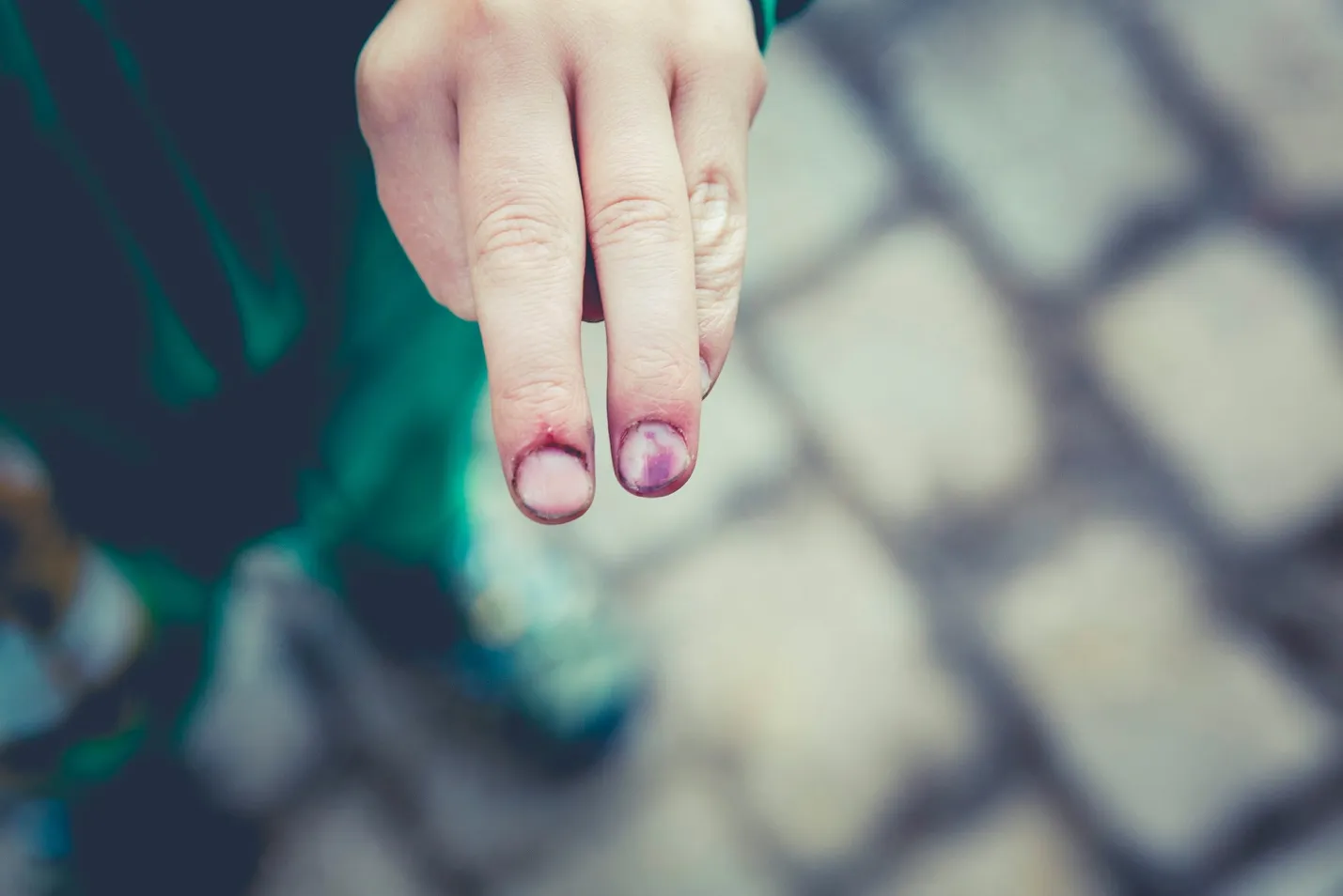 A Complete Guide to Nail Infections and Their Treatment