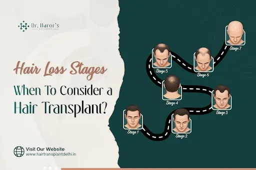 Hair Loss Stages: When To Consider a Hair Transplant?