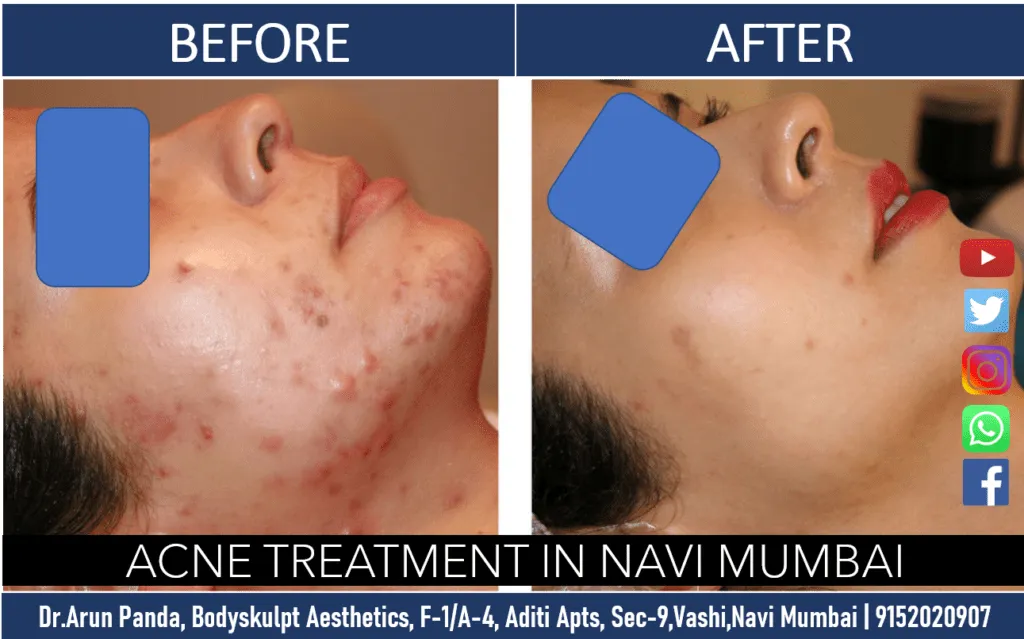 Cost of Acne Treatment in Navi Mumbai: What Every Patient Should Know Before Starting Treatment