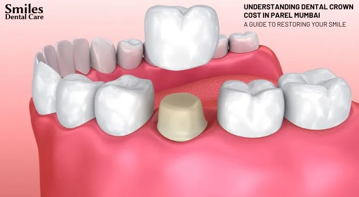 Understanding Dental Crown Cost in Parel Mumbai: A Guide to Restoring Your Smile