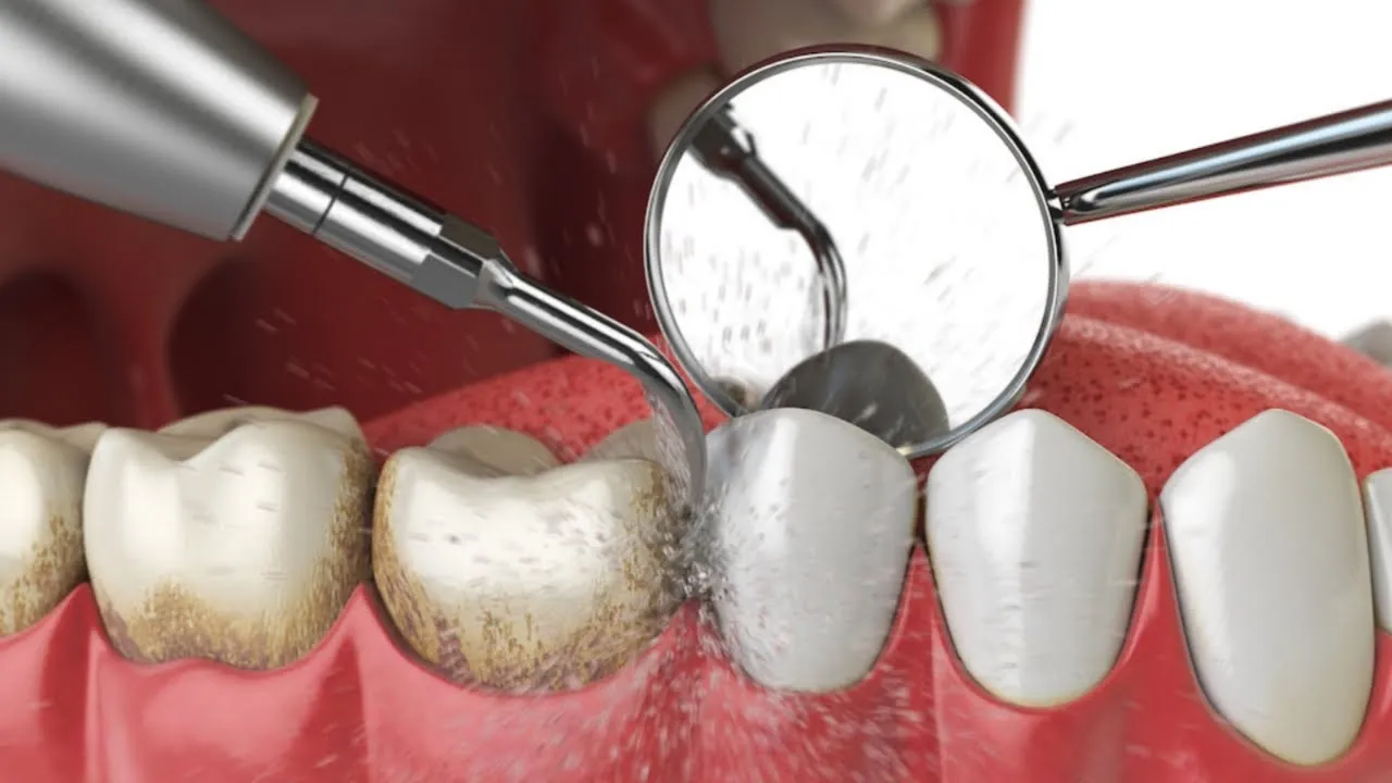 Understanding Teeth Cleaning Charges: What Affects the Cost and Why It’s Worth It