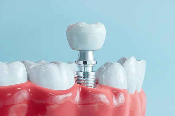Permanent Tooth Replacement Solutions for a Stronger, Healthier Smile