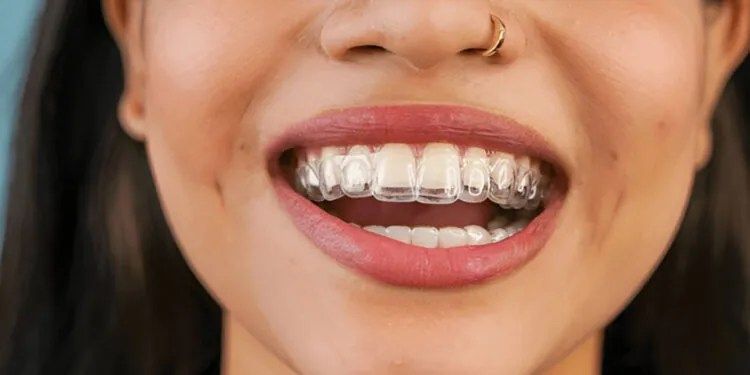 What Affects the Time Orthodontic Aligners Need to Straighten Teeth?