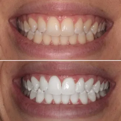 How Can You Keep Your Teeth White Without Damaging Enamel?