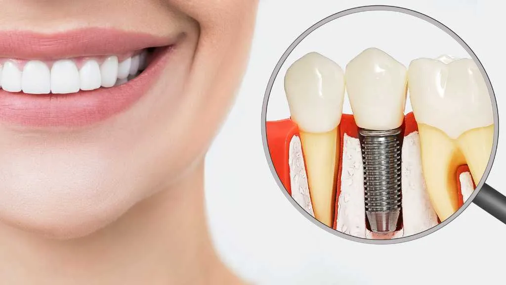 Benefits of Dental Implants You Should Know About
