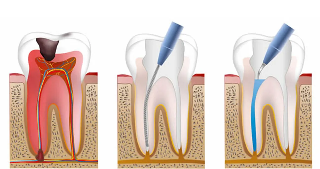Benefits of Root Canal Treatment for Infected Teeth