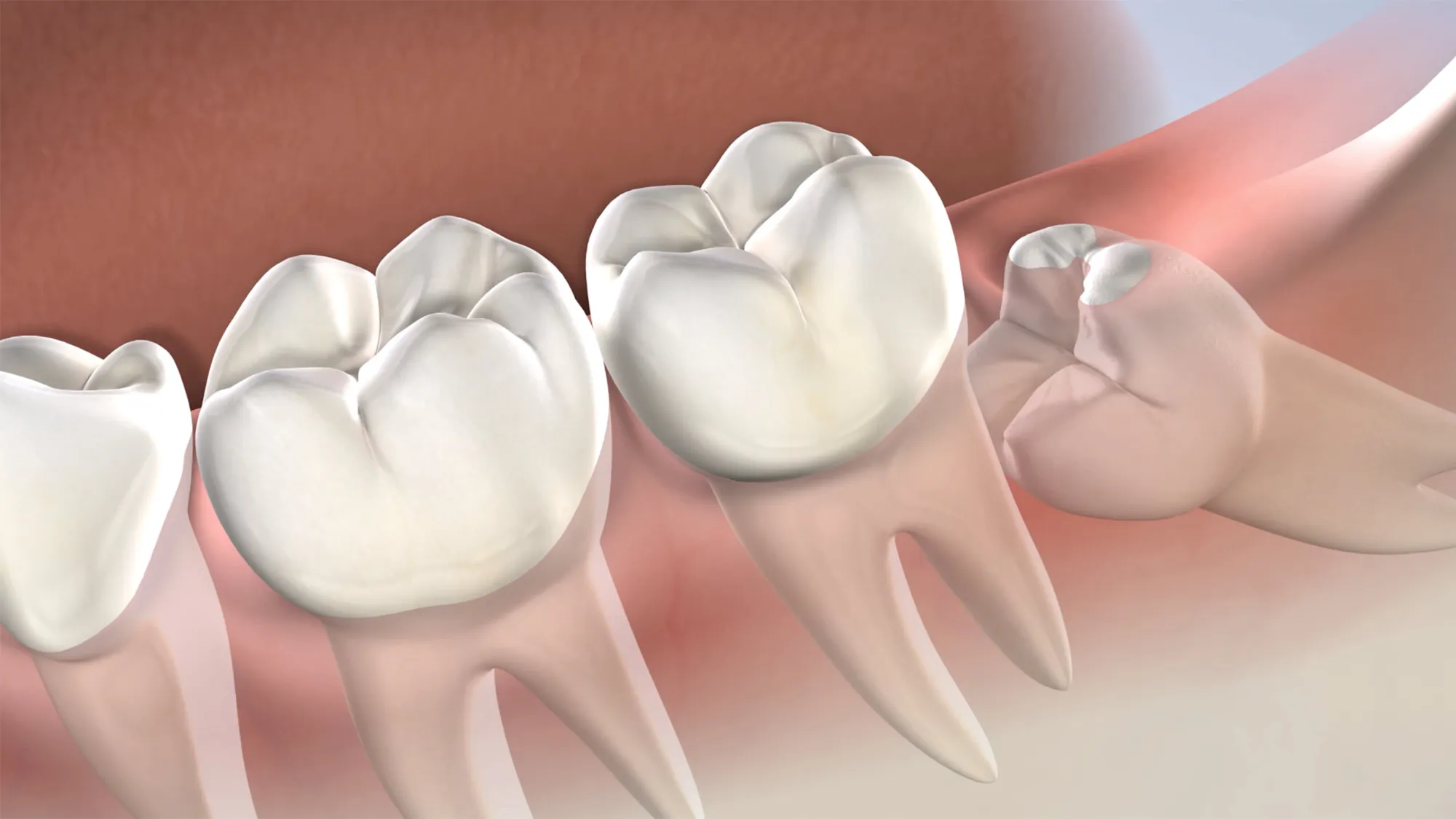 Wisdom Tooth Removal Side Effects: Causes, Prevention & Recovery Tips