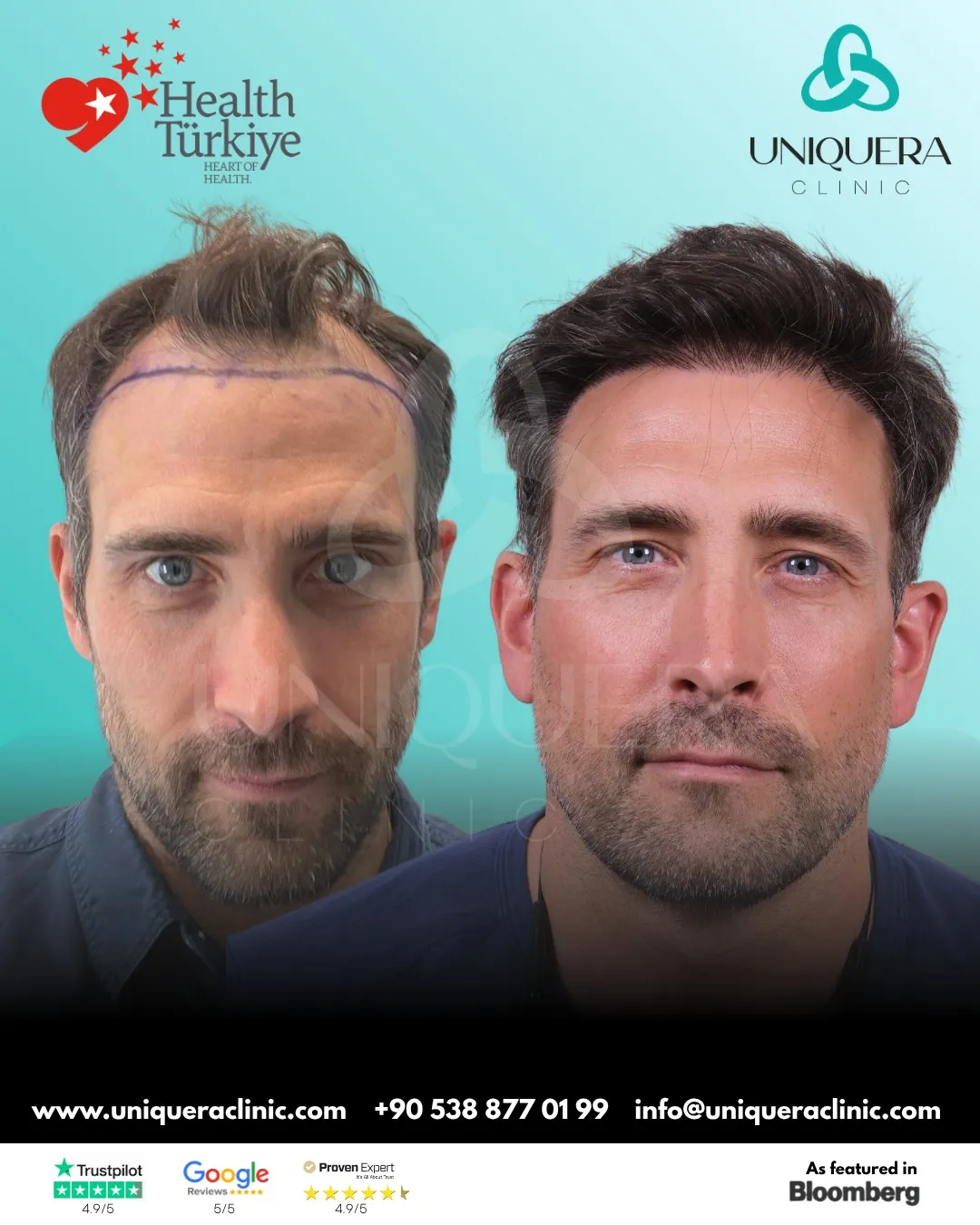 How to Choose the Top Hair Transplant Clinics in Turkey