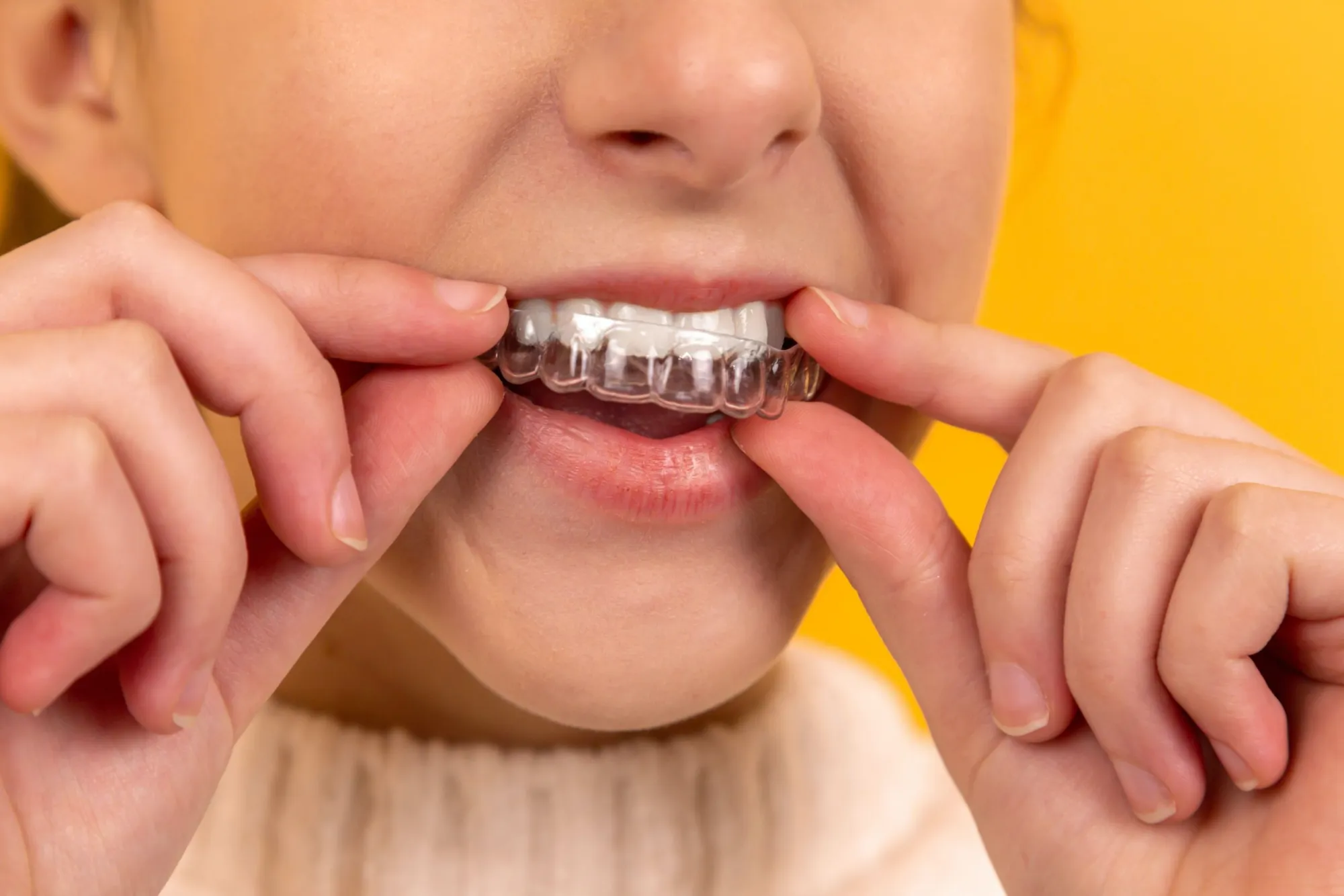 Where Can I Get Invisalign for Teenagers and Affordable Braces?
