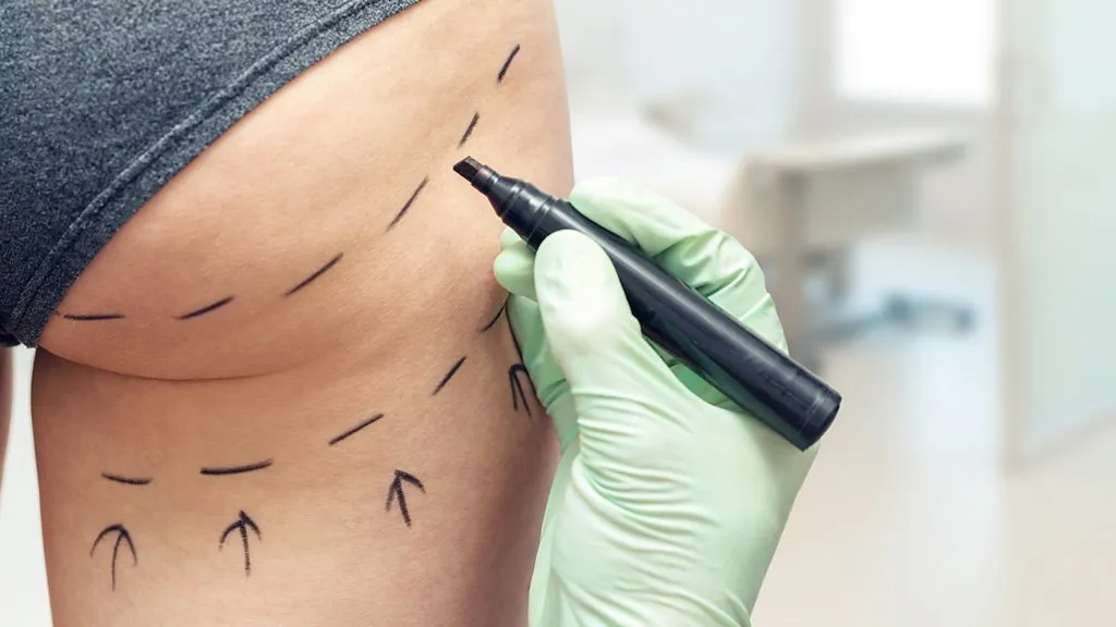How Long Does a Non-Surgical BBL Last? Expert Insights