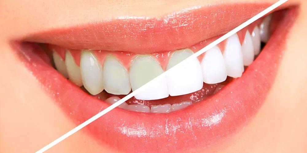 Why Teeth Whitening Is Becoming Popular Before Weddings and Events