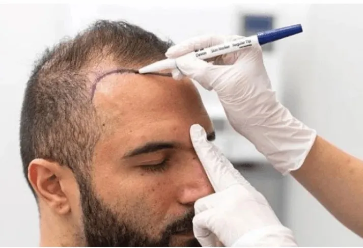 Hair Transplant in Delhi: What Affects the Final Graft Count?
