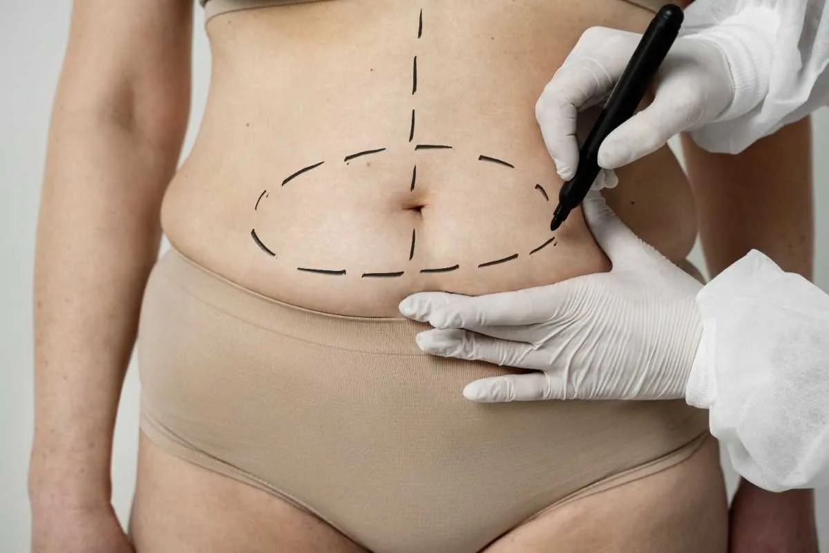 Can Liposuction Treat Belly Fat Permanently?