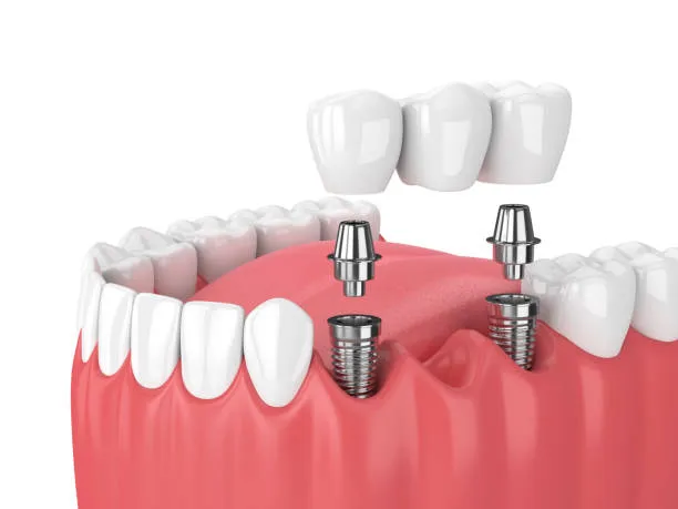 Are Permanent Dental Implants Better Than Temporary Tooth Replacement Options?