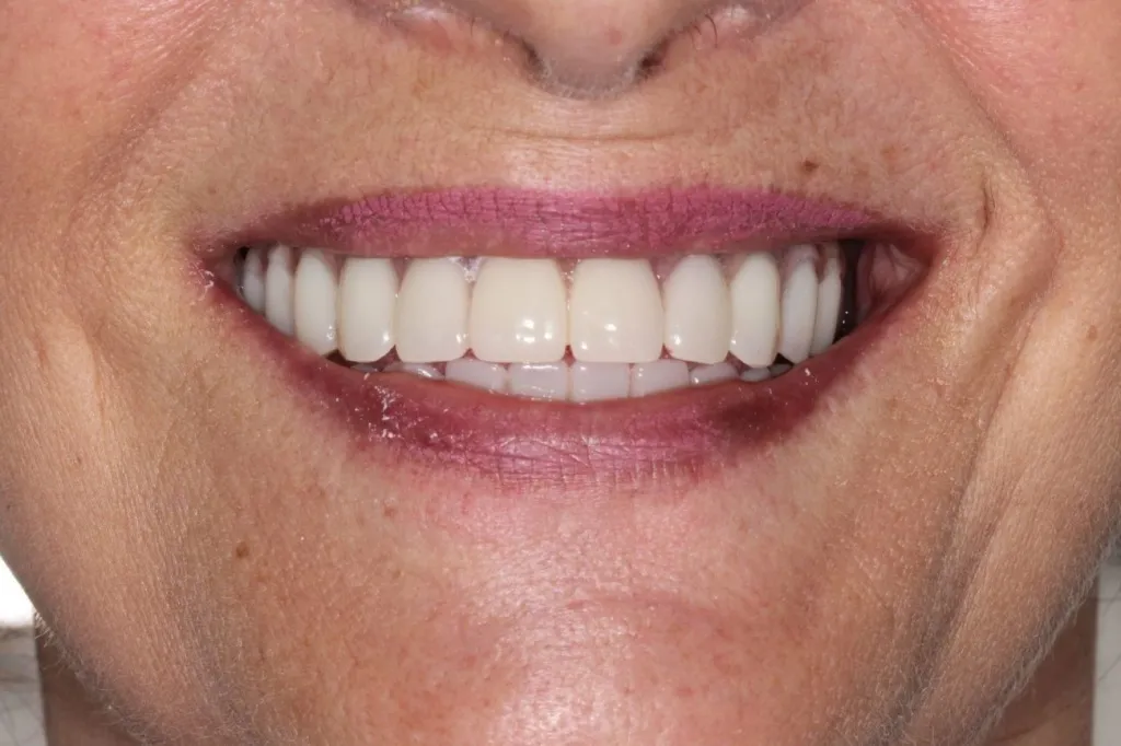 No Teeth or Multiple Missing Teeth? Explore Full Mouth Rehabilitation in Hinjewadi