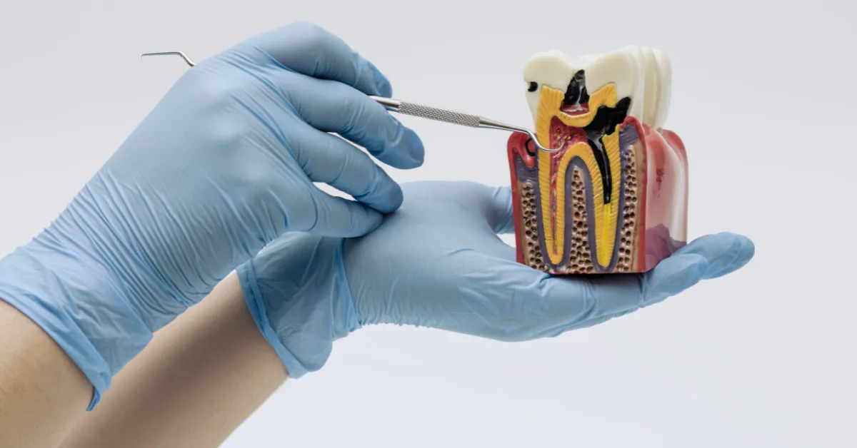 Benefits of Root Canal Treatment for Saving Natural Teeth