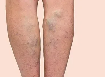 Excision Skin Cancer in Melbourne: Procedure, Recovery, and Aftercare
